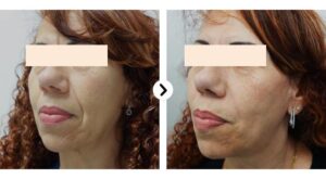 hifu-kep-4-iskin-kft